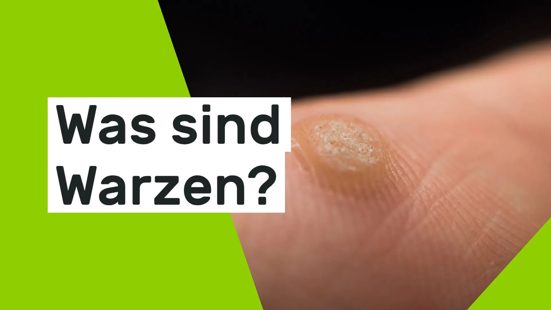 Das hilft gegen Warzen