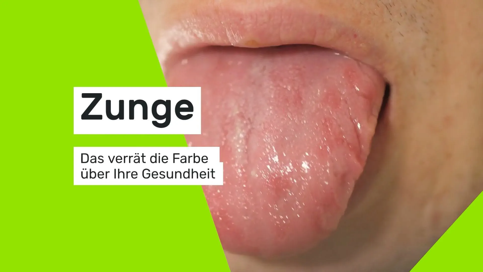 Das verrät die Zungenfarbe über Ihre Gesundheit